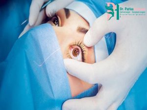 عمل جراحی لازک چشم